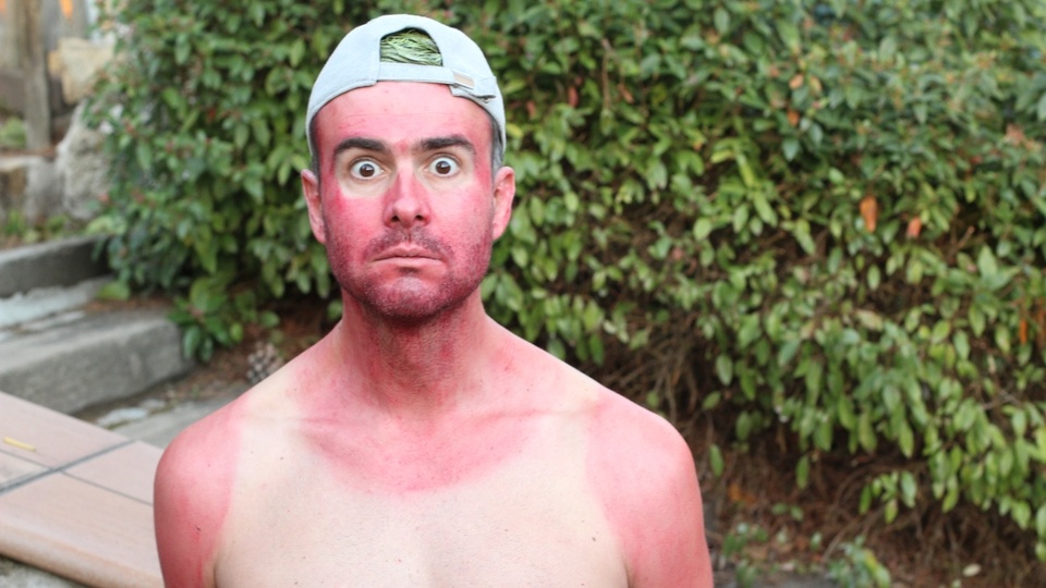 sunburned-man-ballcap-1